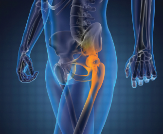 Post Hip Replacement Image